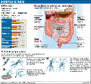 Cáncer de colon